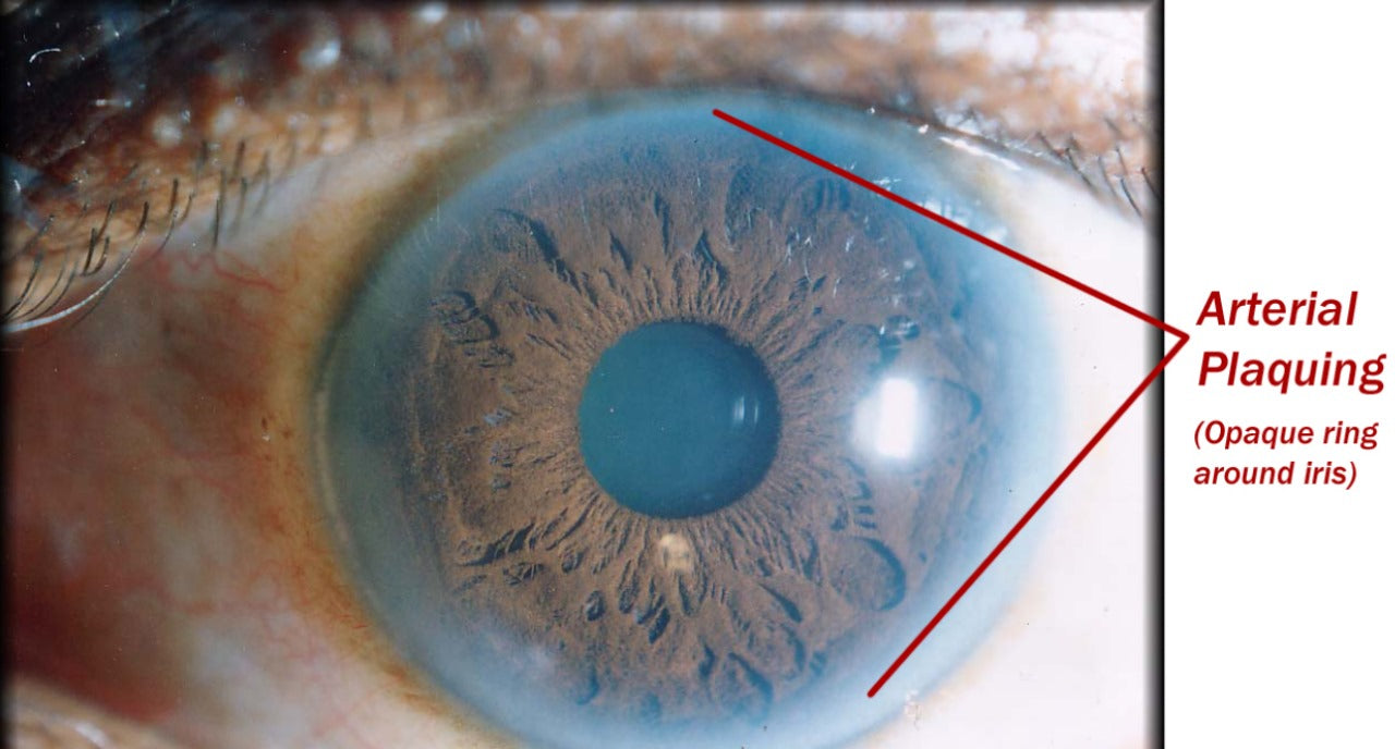 Iridology Assessment Consultation with supportive Phyto-Medicine (herbal) protocol.