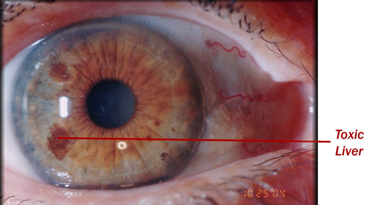 Iridology Assessment Consultation with supportive Phyto-Medicine (herbal) protocol.