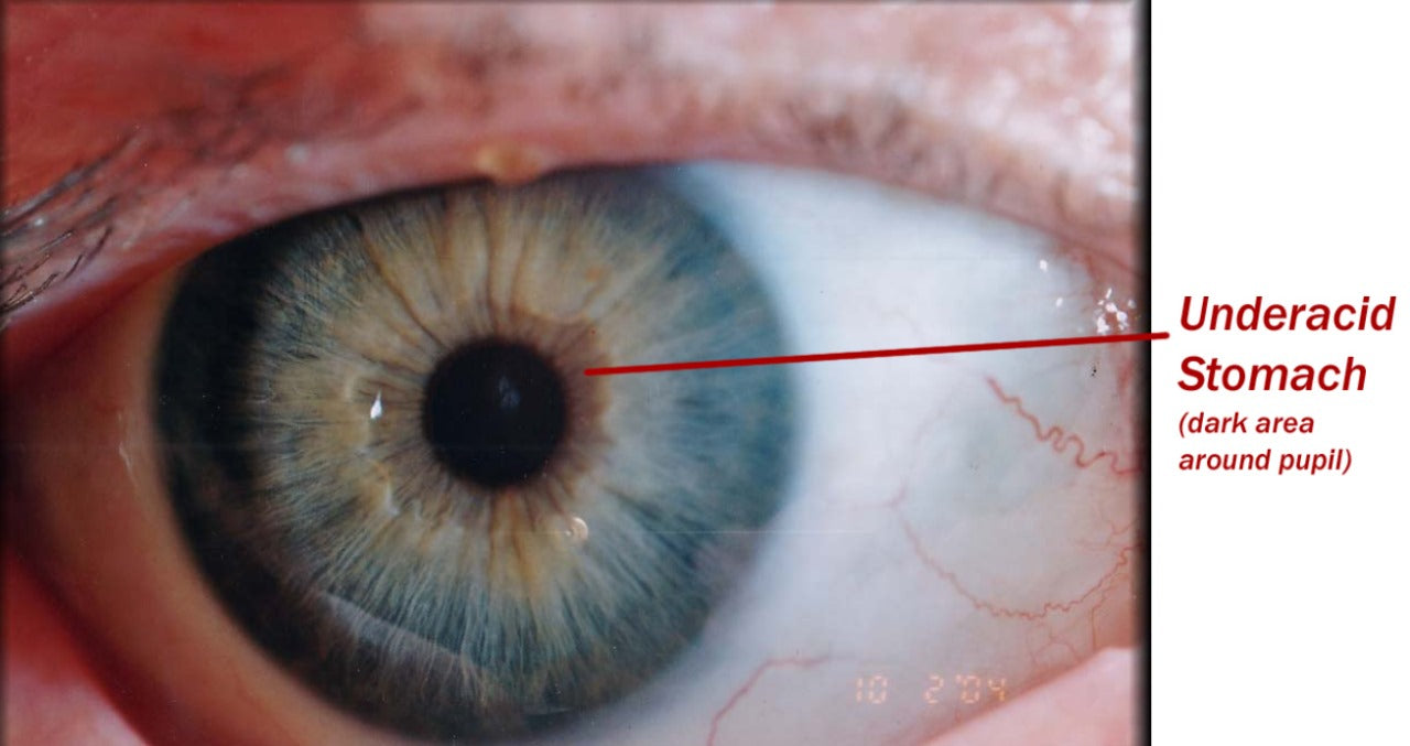 Iridology Assessment Consultation with supportive Phyto-Medicine (herbal) protocol.